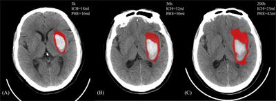 <mark class="highlighted">Perihematomal Edema</mark> After Intracerebral Hemorrhage: An Update on Pathogenesis, Risk Factors, and Therapeutic Advances